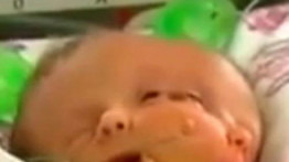 Kétarcú baba született – videó