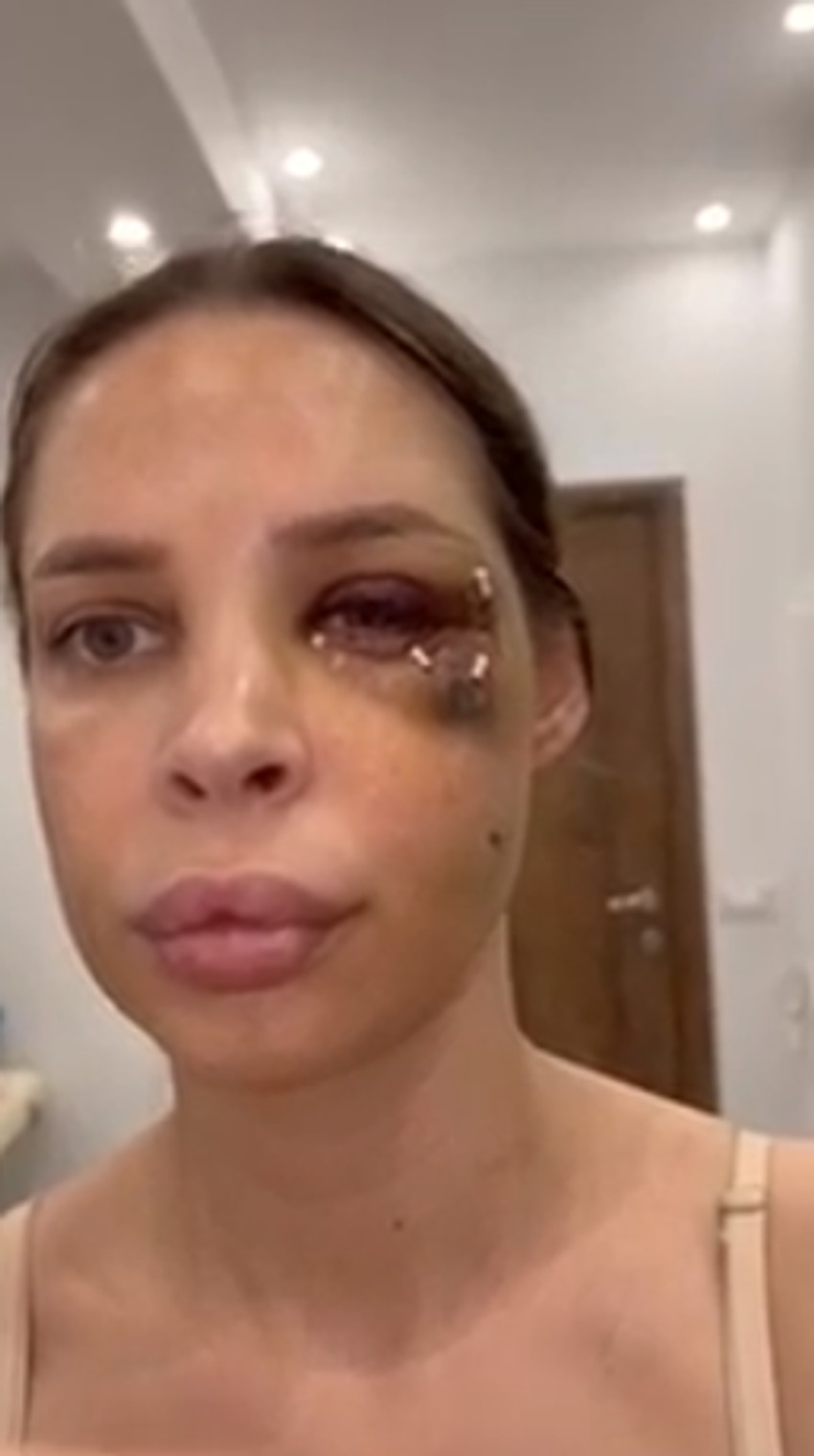 Nataša Šavija nakon operacije