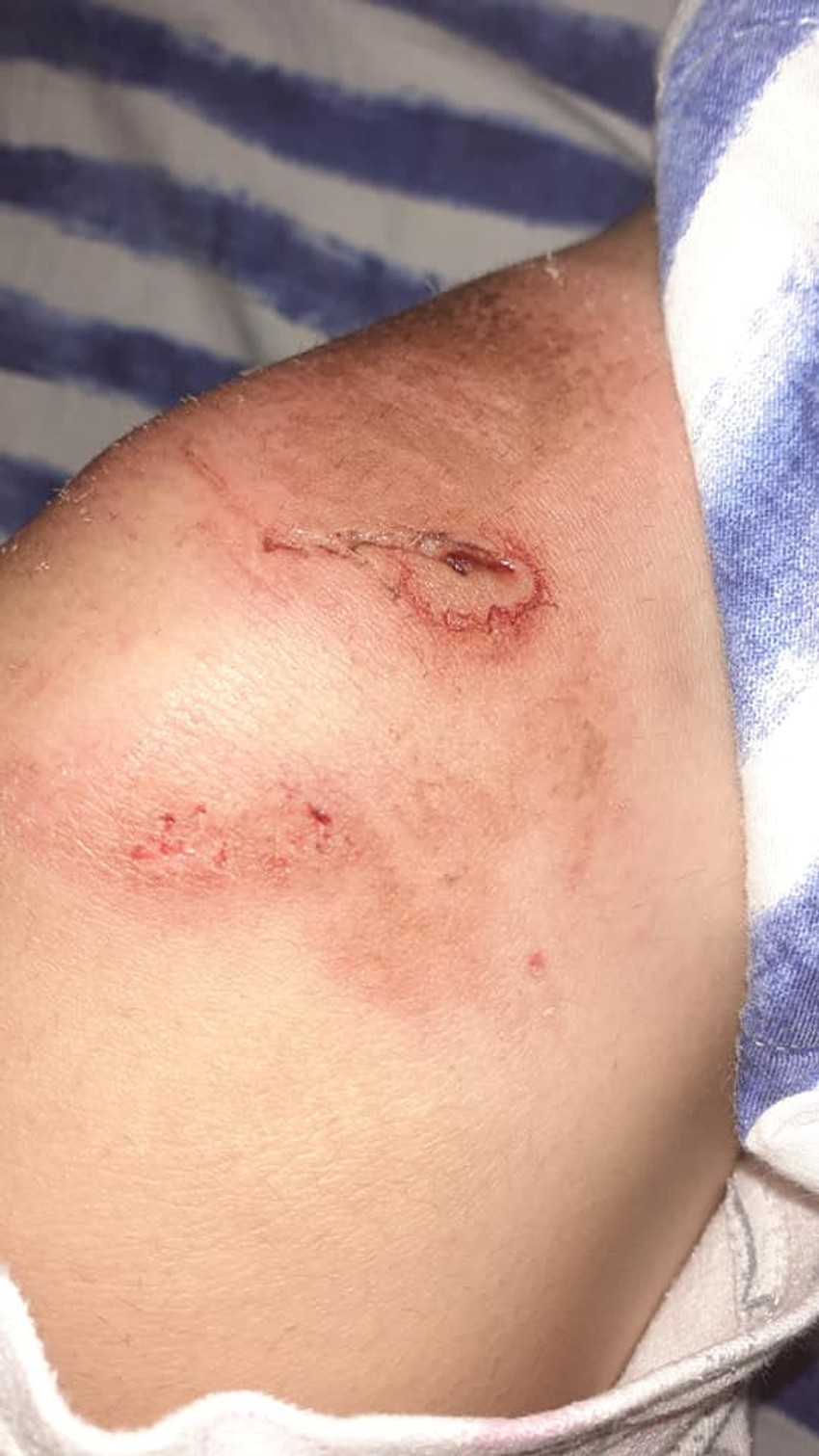 Povrede koje je devojčica zadobila tokom napada psa