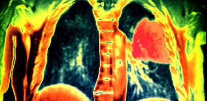 Te nowotwory w Polsce zabijają najczęściej