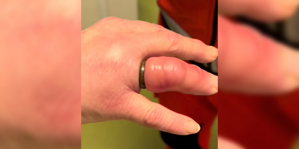 Palec kobiety spuchł tak, że było o krok od amputacji. Ratownik pokazał nagranie.