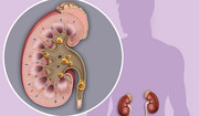 Objawy, które świadczą o tym, że masz złogi w nerkach