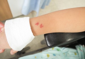 Sistemske bolesti vezivnog tkiva i vaskulitisi i dalje ostaju izazov za pedijatrijske reumatologe širom sveta 