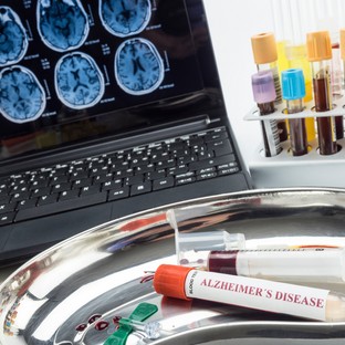 Mérföldkő az Alzheimer-kór diagnózisában – itt az első vérvizsgálati teszt, amit az FDA is jóváhagyott