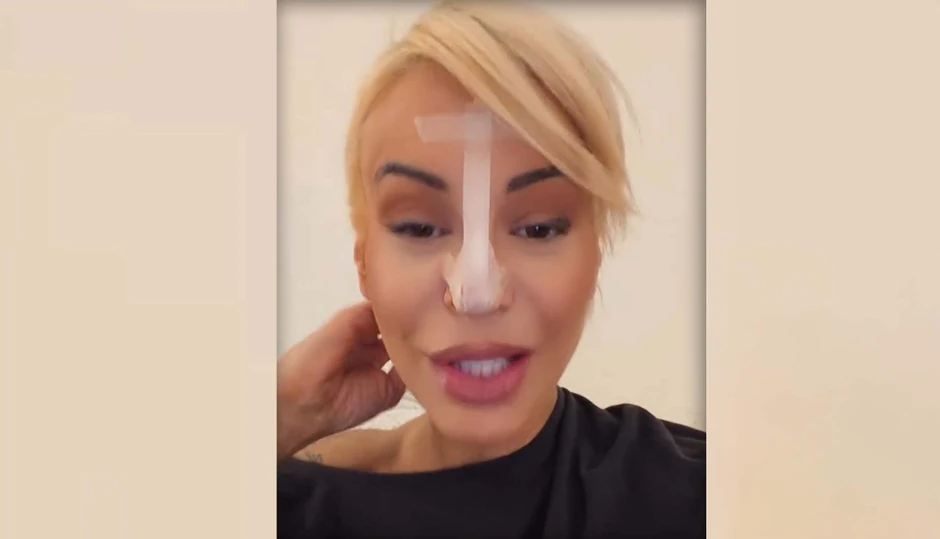 Dušica Jakovljević skroz oblepila nos flasterima, šokira: "Pao mi je vrh" nosa"