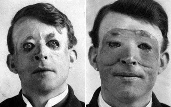 Walter Yoe – brytyjski marynarz ranny w czasie I wojny światowej. To właśnie na nim po raz pierwszy w historii dokonano zabiegu przeszczepu skóry na twarzy. Dzisiaj trudno uznać taki zabieg za udany