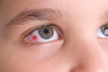Figyeljen a jelekre - Súlyos betegségekre utalhat a véreres szem - Blikk