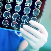 Stroke: ezért növeli a napi nyolcórás ücsörgés a kockázatát