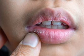 Dermatolog otkriva uzroke suvih i ispucalih usta i kako ih pravilno negovati