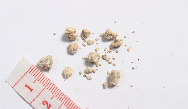 Bubrežni kamenčići