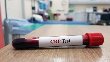 Mit jelent a CRP érték a laborleleten?