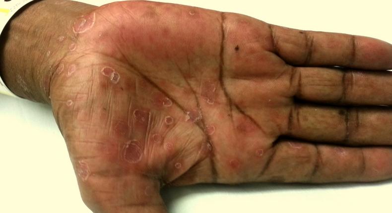 hand rash (Academic Life in Emergency Medicine)