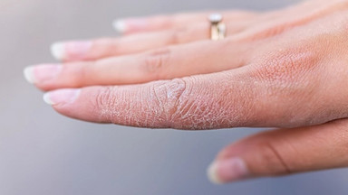 Tania maść z apteki uratuje ci skórę dłoni zimą. Koniec z krwawiącymi pęknięciami