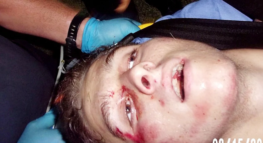 Komadi mesa u ustima mladića