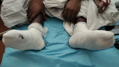 Walka o stopy 18-latka z Ghany. "Zatrzymaliśmy chorobę"