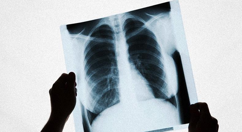 how long you sleep predict lung cancer