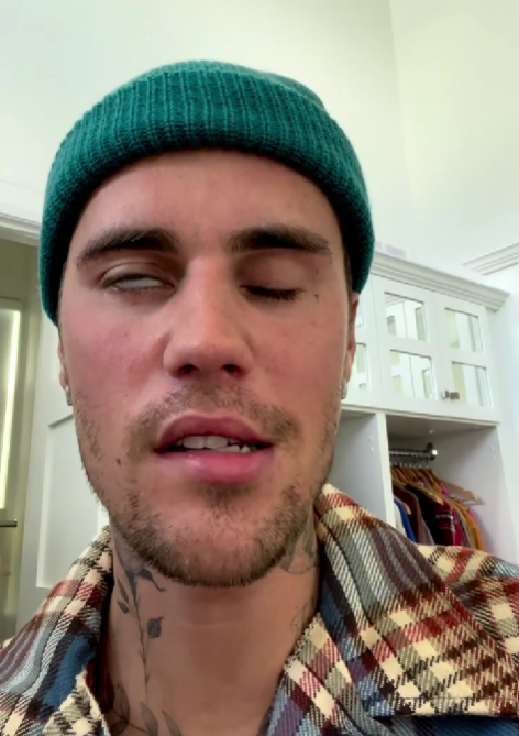 Justinovi Bieberovi ochrnula časť tváre. 