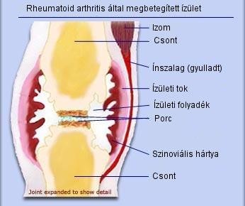 térdízületi gyulladás kezelése 1