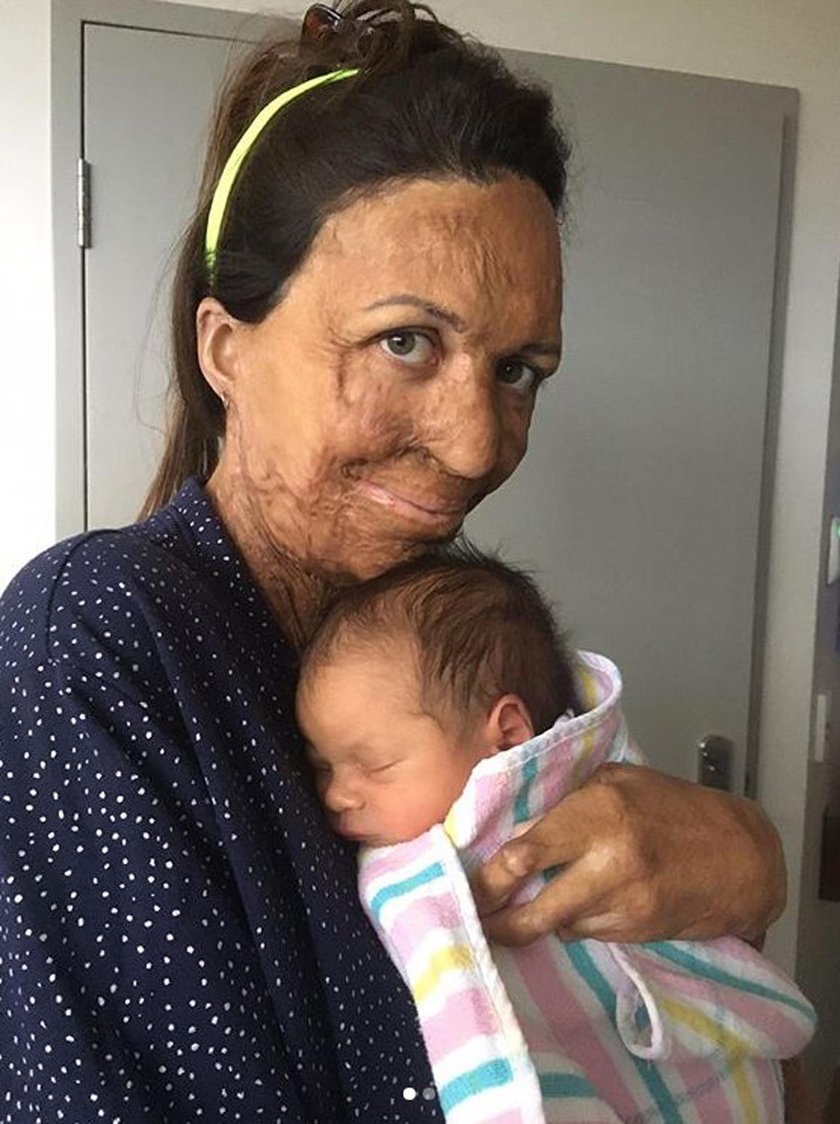 Modelka Turia Pitt omal nie spłonęła żywcem. Teraz została mamą