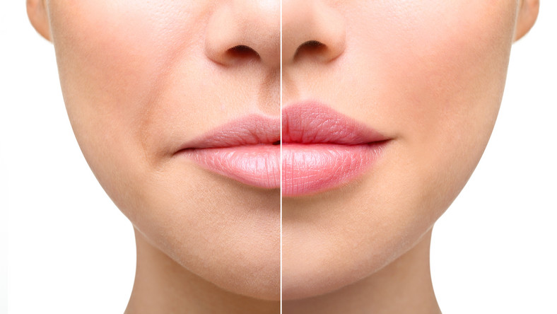 Powiększanie ust – naturalne, kwasem hialuronowym. Porady 