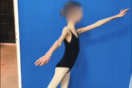 Devojčicu doveli u bolnicu, imala je samo 28 KG I RUČICE TANKE KAO GRISINE: Kad su lekari shvatili koliko ima godina, samo su se UHVATILI ZA GLAVU