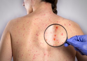 Rubeola je zarazna - širi se sa osobe na osobu kada se kašlje, kija...