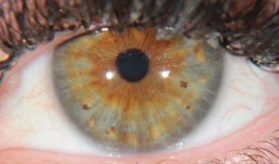 Karline oči nakon udara