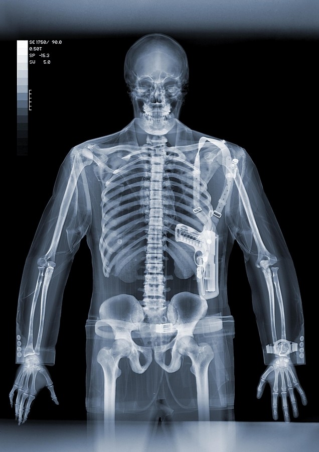 NICK VEASEY x-ray