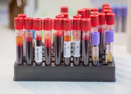 "Dziwne, lepkie struktury we krwi". To odkrycie może tłumaczyć długi COVID