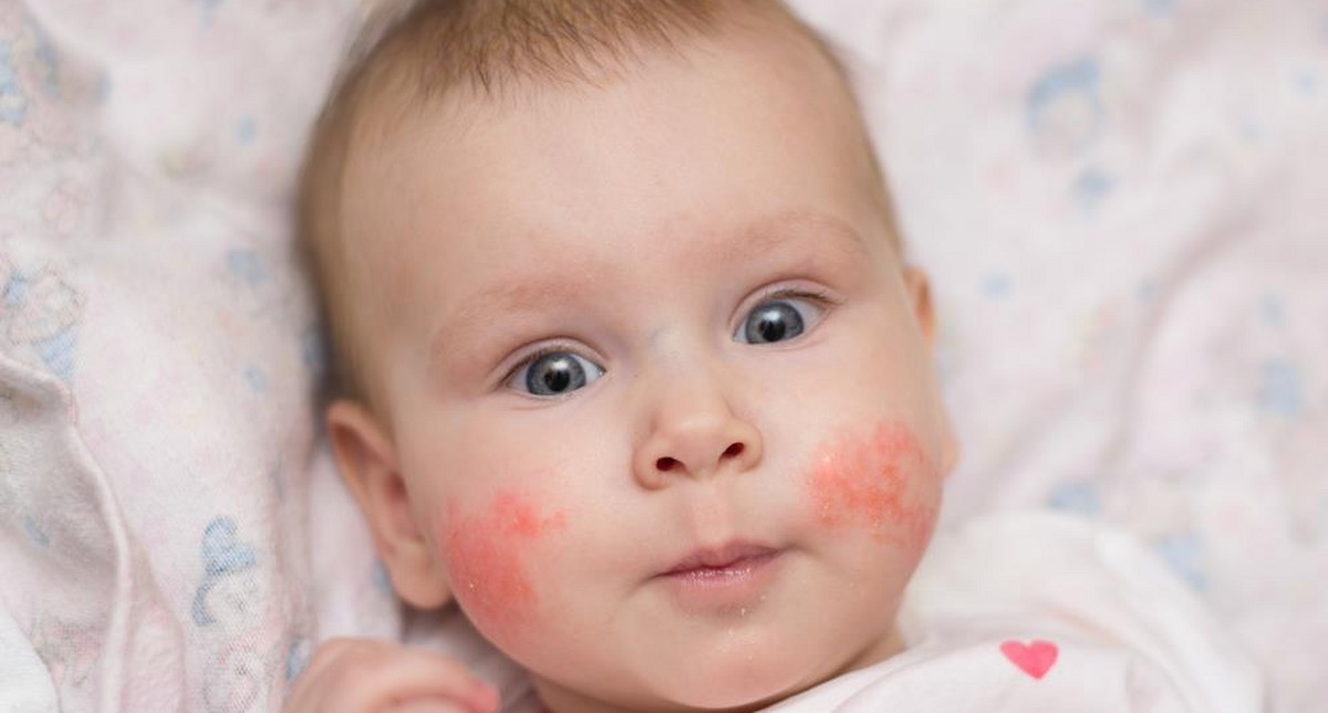 Czerwone plamy na ciele u dziecka oraz alergie. O co chodzi?