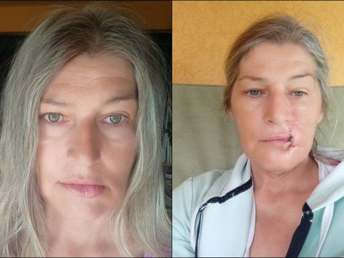 Zorka iz Kragujevca je dane provodila na suncu i biciklu, a onda je na usni primetila ranu