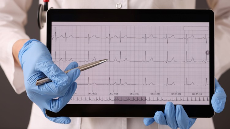 szívritmuszavar szívprobléma pitvarfibrilláció jele stroke tünete