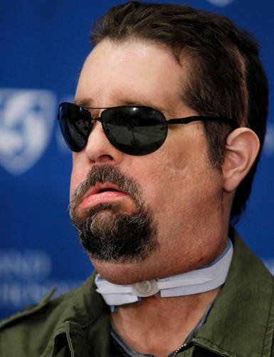 Dallas Wiens. Przeszedł przeszczep twarzy