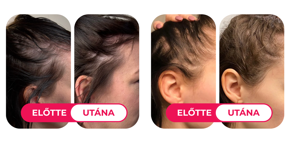 Már néhány hét alatt látható a The Silky Way kúrájának eredménye, amely hajhullásra, hajritkulásra kínál megoldást