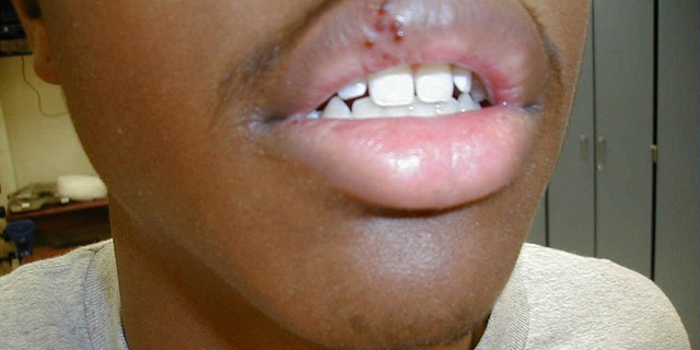 Natural Ways To Get Rid Of Cold Sores Pulselive Kenya