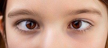 A szemtengelyferdülés, vagyis az asztigmia a rövid- és távollátás után a harmadik leggyakoribb fénytörési hiba. Akkor beszélünk szemtengelyferdülésről, ha a két szem nézővonala a távolba tekintve nem párhuzamos.