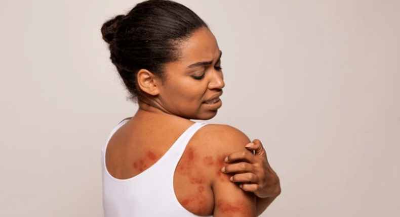 Spot and treat heat rash [Shutterstock]