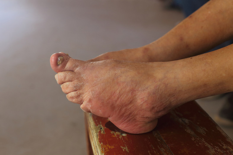 Stopy 97-letniej kobiety urodzonej w 1919 r. Ostatnie pokolenie Chinek, którym bandażowano stopy