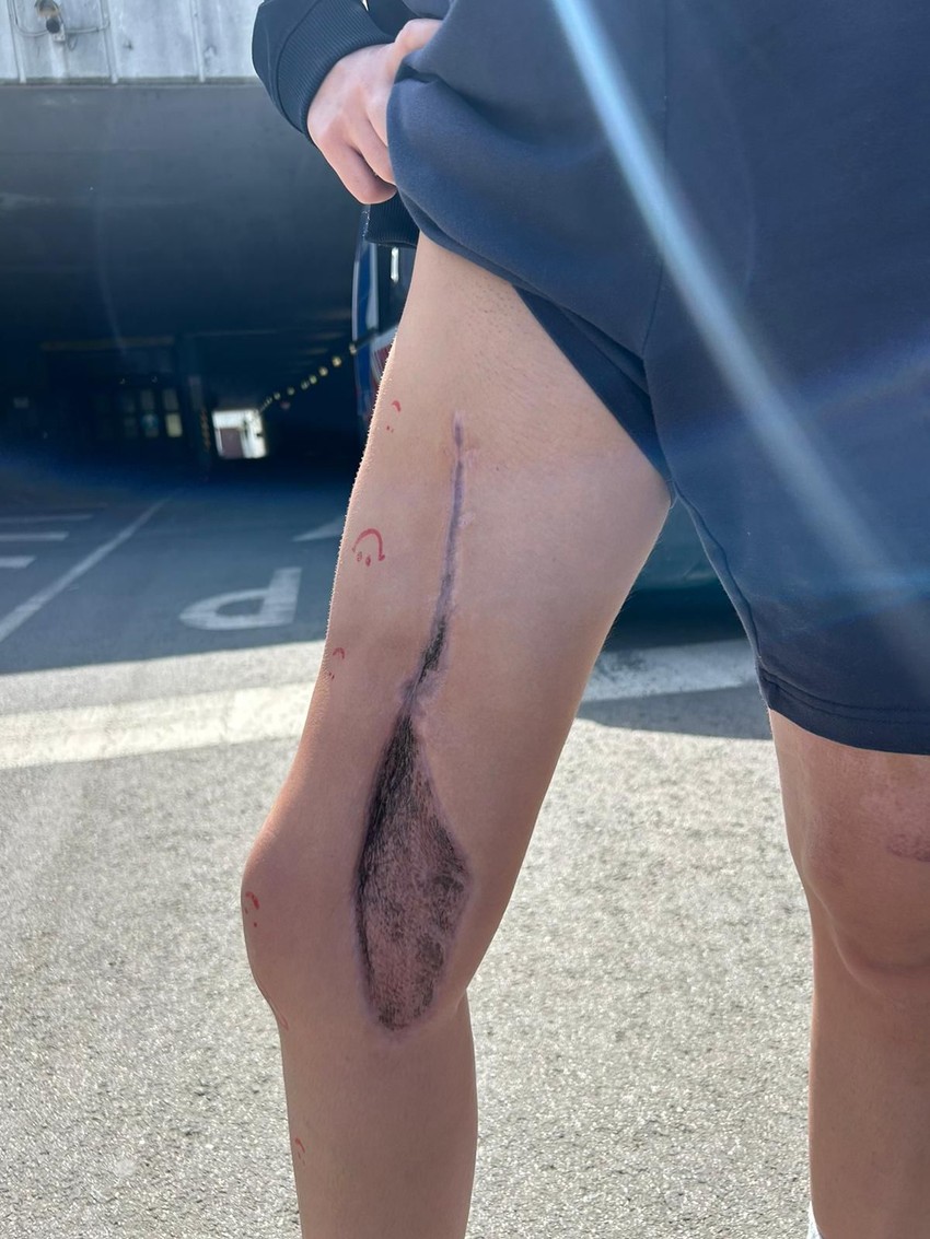 Imala je užasne bolove, davali su joj trodone i morfijum, a kada bi se probudila iz anestezija vrištala je od bolova