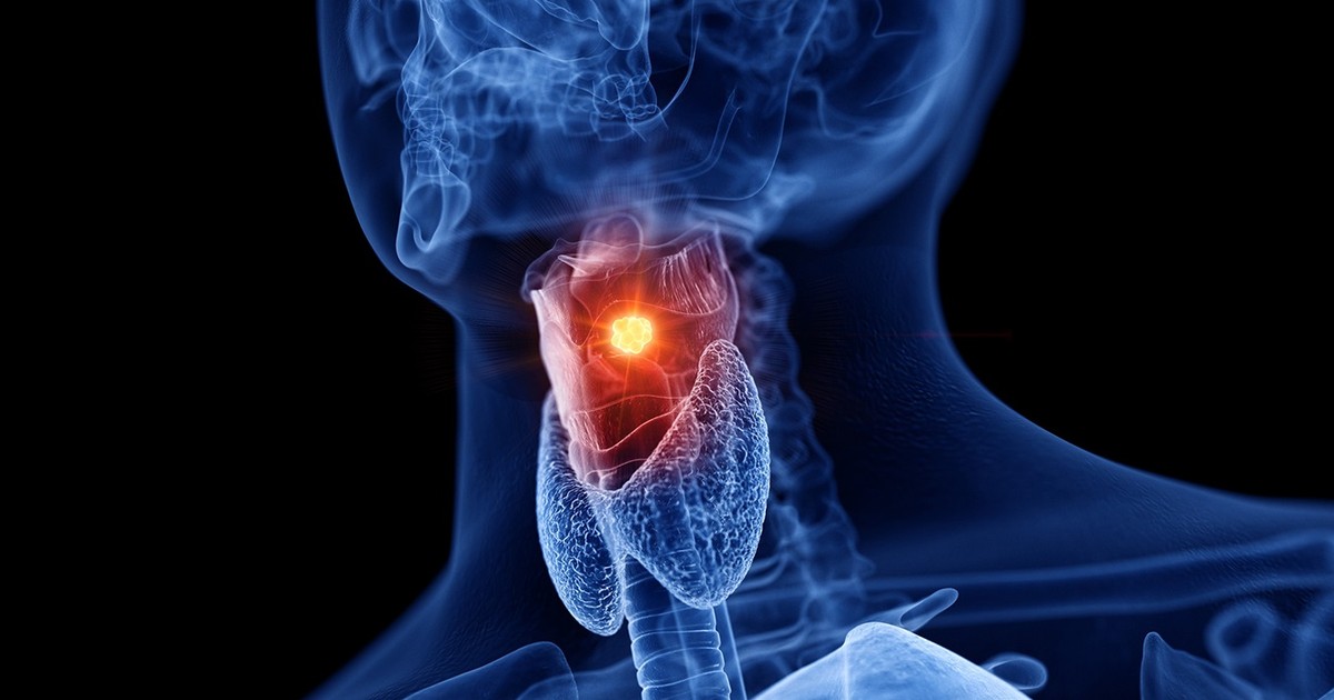 Saratani ya Oropharyngeal inazidi kuongezeka, haswa kutokana na virusi vya papilloma ya binadamu (HPV) ambayo inawajibika kwa 70% ya kesi. Uelewa na chanjo ya vijana ni muhimu ili kukabiliana na ugonjwa huu. Chanjo ya HPV, yenye ufanisi zaidi ya 80%, ni muhimu, lakini viwango vya chanjo vinapungua. Kuna haja ya haraka ya kuongeza ufahamu wa hatari zinazohusiana na HPV na kuhimiza chanjo kutoka kwa umri mdogo ili kulinda afya ya vizazi vijavyo.