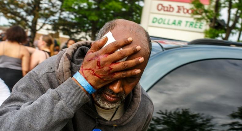 A Somali-American man injured when protesters clashed with police during demonstrations against the death of George Floyd in  Minneapolis on May 27, 2020 -- African refugees have joined the protests against racism