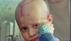 Alek Žloba sedi na dečjem odeljenju za rak sa oznakama koje su mu lekari napravili na glavi nakon hemoterapije u Gomelu, Belorusija, 19. marta 1996. godine, skoro 10 godina nakon eksplozije i požara u nuklearnoj elektrani Černobilj