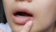 Zajady na ustach - objawy, przyczyny, leczenie pękających kącików ust 