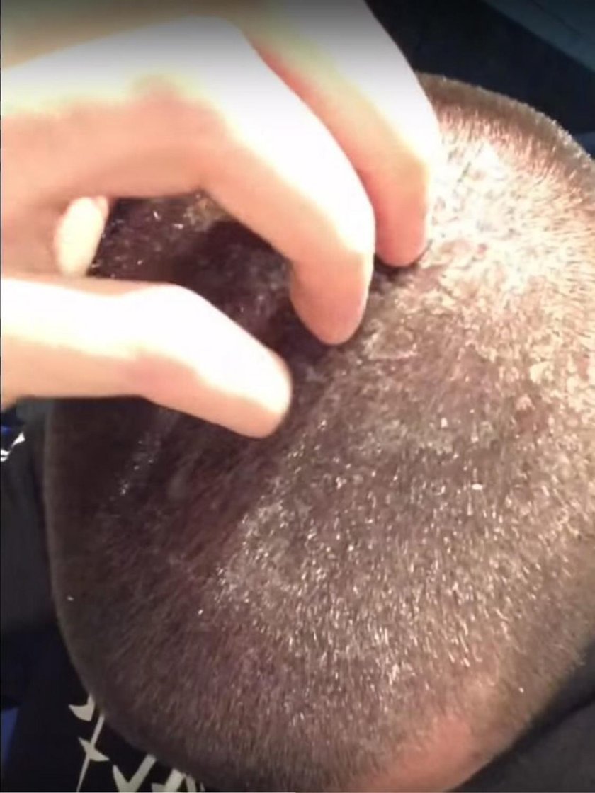 Flaky Scalp