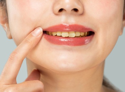 6 étel és ital, amitől elszíneződhetnek a fogai című cikk nyitóképe