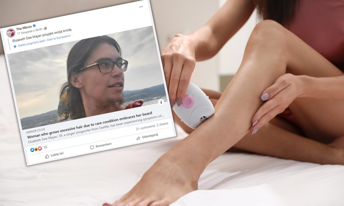 Kobiety, które cierpią na tę chorobę, ukrywają twarz. Ona z dumą nosi zarost