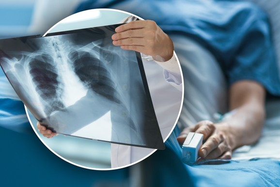 (VIDEO) "Neće da dođu na preventivni pregled, plaše se da će im 'NEŠTO NAĆI', a onda bude kasno": Lekari o raku pluća od koga godišnje umre 5.000 ljudi i važnosti skrininga