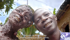 She rejected me many times – Husband of woman with skin condition tells love story (video)