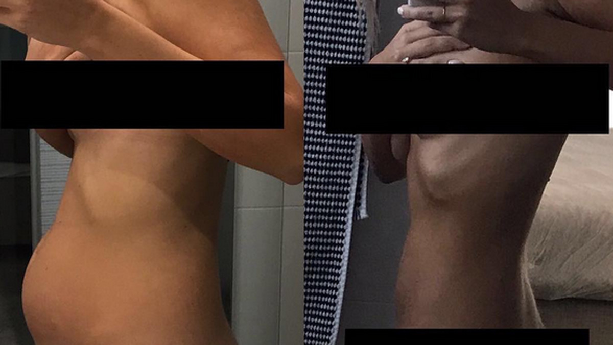 Thessy Kouzoukas to 27-letnia Australijka chorująca na endometriozę. Thessy otwarcie mówi o swojej chorobie w mediach społecznościowych. Niedawno pokazała zdjęcie, na którym możemy zobaczyć, jak bardzo ta choroba zmienia ciało.