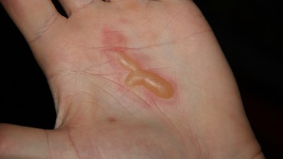 A palm with blisters
